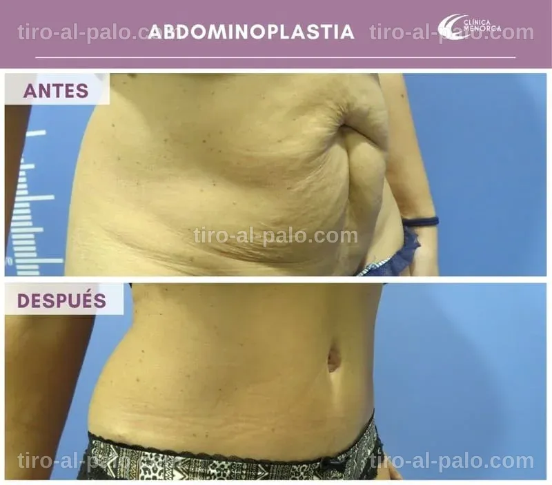 Profesionales discutiendo sobre abdominoplastia en Santiago.
