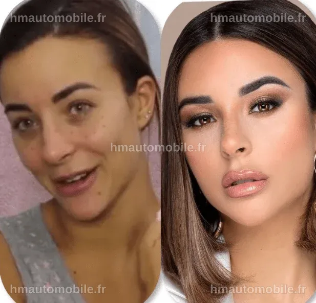 Rym Renom après la chirurgie, révélant des changements notables dans son apparence.