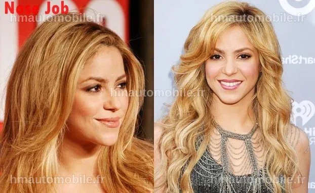 Discussion sur le nombre de chirurgies esthétiques de Shakira.